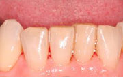 After Air polish from Velopex - Ultimate hygienist clean using Pro Sylc