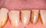 Before Air polish from Velopex - Ultimate hygienist clean using Pro Sylc